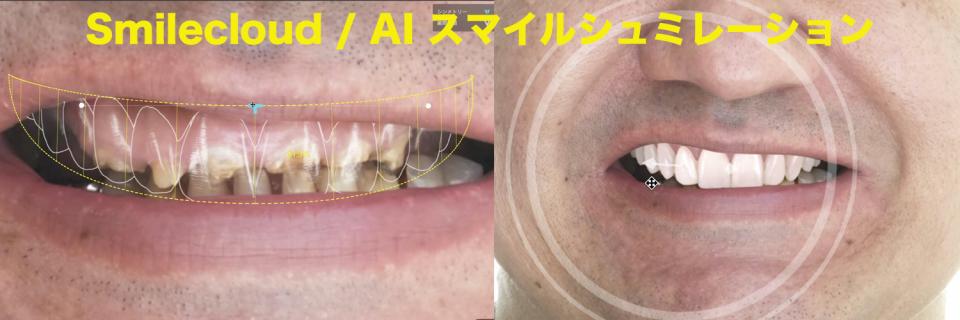 歯がボロボロで悩んでいる方へ ― オールオン4という選択肢