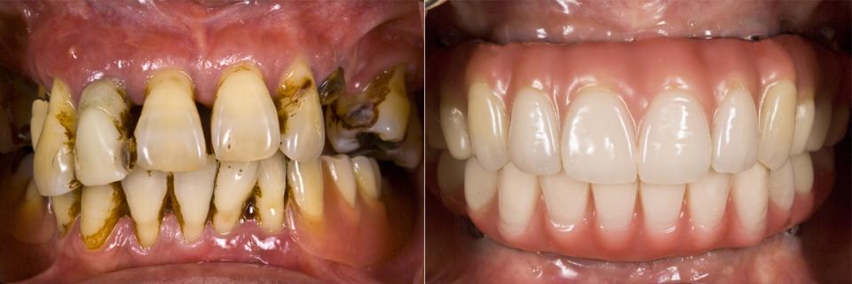 歯がボロボロで悩んでいる方へ ― オールオン4という選択肢