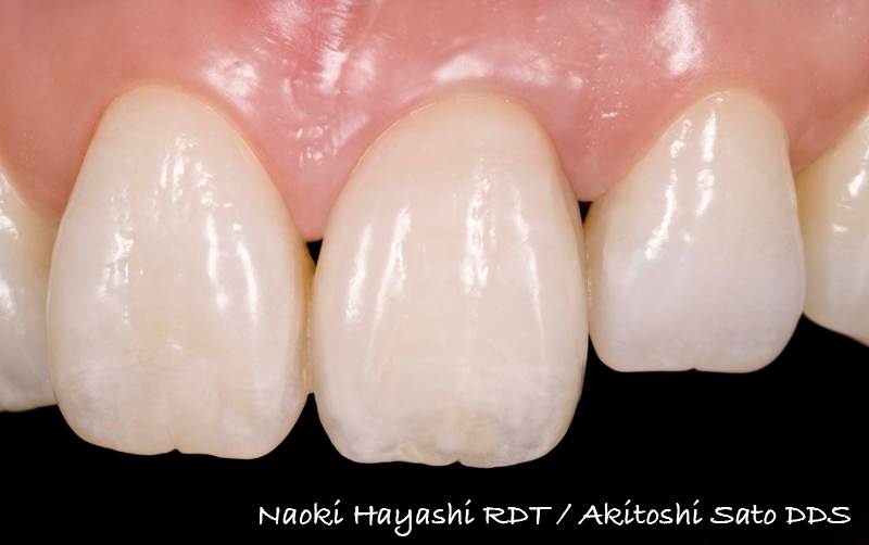 抜歯即時埋入症例（抜歯直後にインプラント植立し当日に仮歯を装着したケース）症例写真9