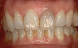 抜歯即時埋入症例（抜歯直後にインプラント植立し当日に仮歯を装着したケース）症例写真7
