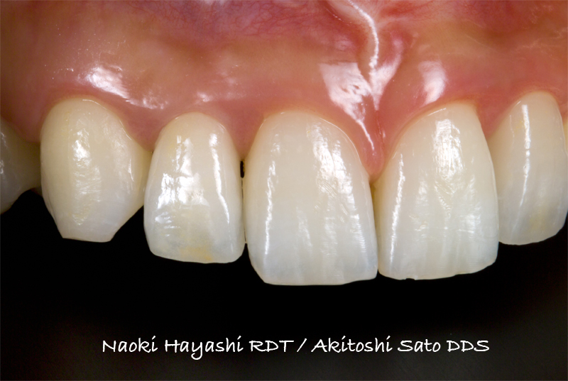 上顎左右側切歯　先天欠損症例 症例写真8