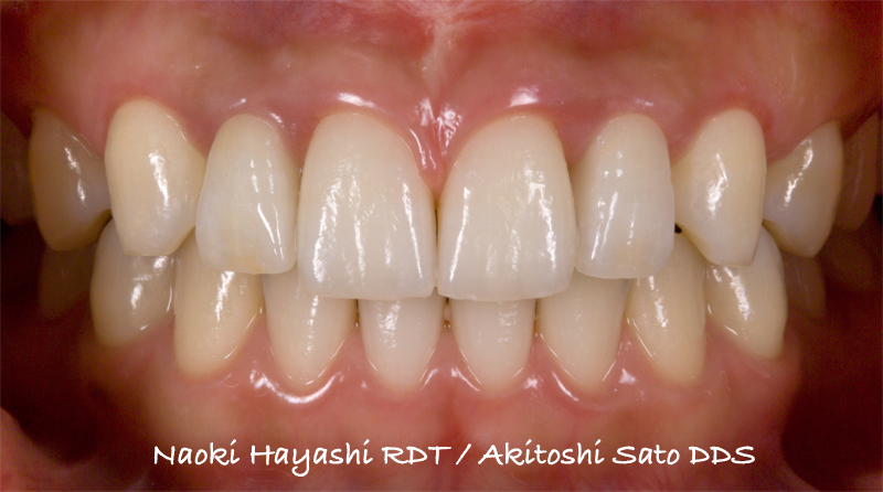 上顎左右側切歯　先天欠損症例 症例写真5