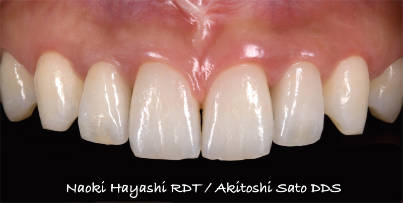 上顎左右側切歯　先天欠損症例 症例写真6