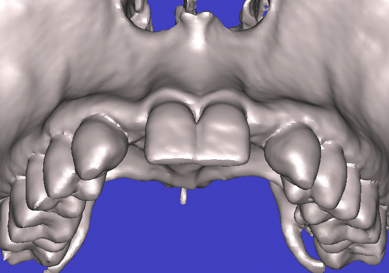 上顎左右側切歯　先天欠損症例 症例写真2