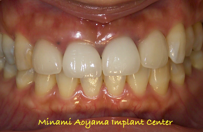 インプラントとセラミック修復による上顎前歯症例 症例写真1