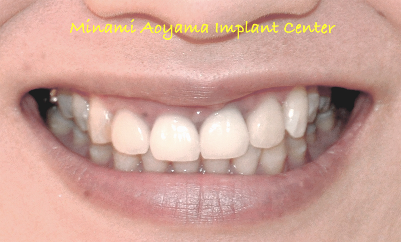 インプラントとセラミック修復による上顎前歯症例 症例写真2