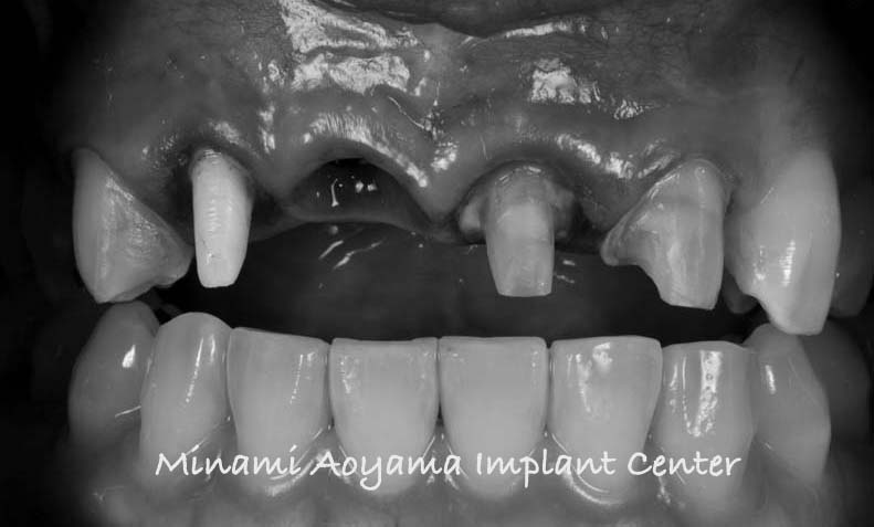 インプラントとセラミック修復による上顎前歯症例 症例写真4