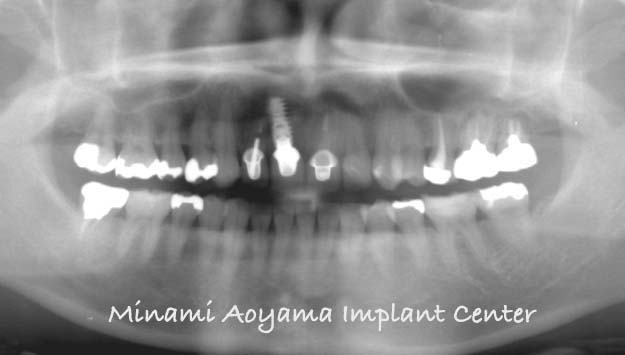 インプラントとセラミック修復による上顎前歯症例 症例写真5