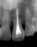 抜歯即時埋入症例（抜歯直後にインプラント植立し当日に仮歯を装着したケース）症例写真2
