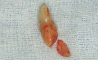 抜歯即時埋入症例（抜歯直後にインプラント植立し当日に仮歯を装着したケース）症例写真3