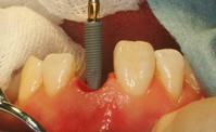 抜歯即時埋入症例（抜歯直後にインプラント植立し当日に仮歯を装着したケース）症例写真4