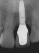抜歯即時埋入症例（抜歯直後にインプラント植立し当日に仮歯を装着したケース）症例写真8