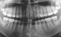 下顎前歯先天欠損症例 症例写真2