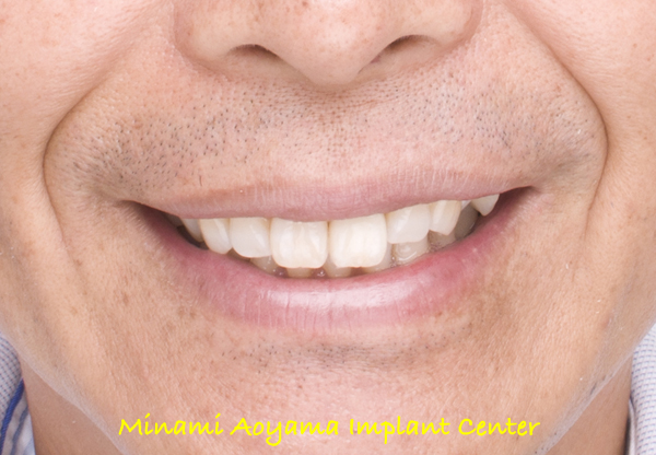抜歯即時埋入症例（抜歯直後にインプラント植立し当日に仮歯を装着したケース）症例写真10