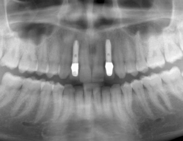 上顎左右側切歯　先天欠損症例 症例写真4