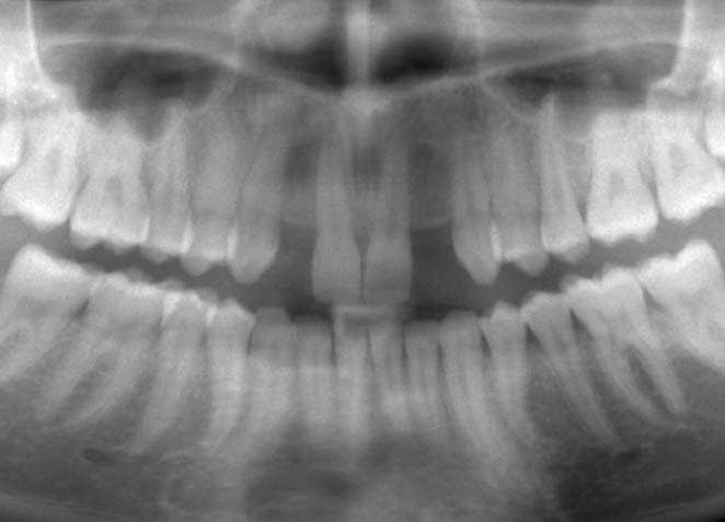 上顎左右側切歯　先天欠損症例 症例写真3