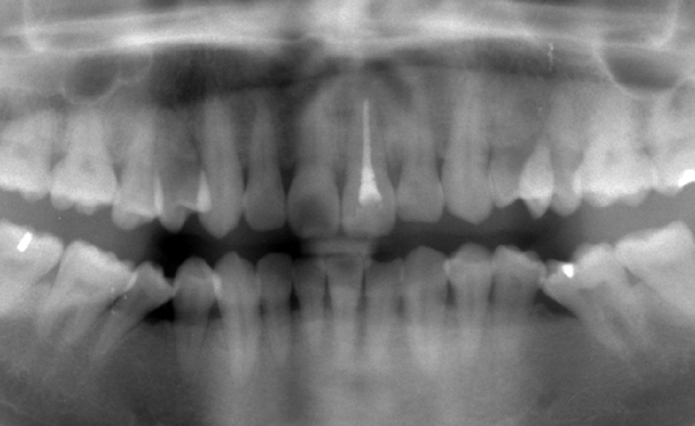抜歯即時埋入症例（抜歯直後にインプラント植立し当日に仮歯を装着したケース）症例写真5