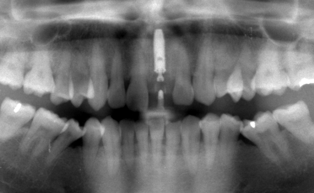 抜歯即時埋入症例（抜歯直後にインプラント植立し当日に仮歯を装着したケース）症例写真6