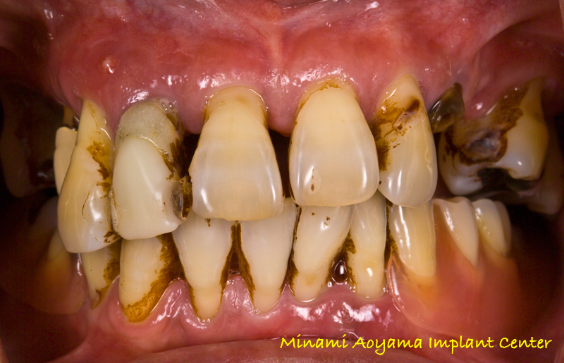 オールオンフォー（上顎全歯抜歯後、インプラント義歯を即日装着） 症例写真1