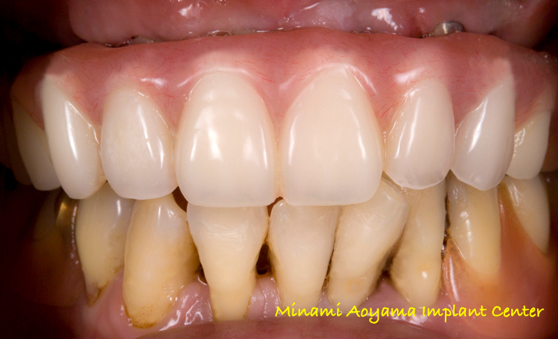 オールオンフォー（上顎全歯抜歯後、インプラント義歯を即日装着） 症例写真2