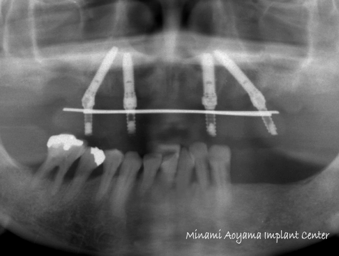 オールオンフォー（上顎全歯抜歯後、インプラント義歯を即日装着） 症例写真4