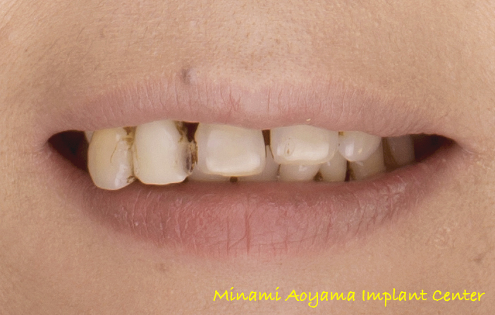 オールオンフォー（上顎全歯抜歯後、インプラント義歯を即日装着） 症例写真5