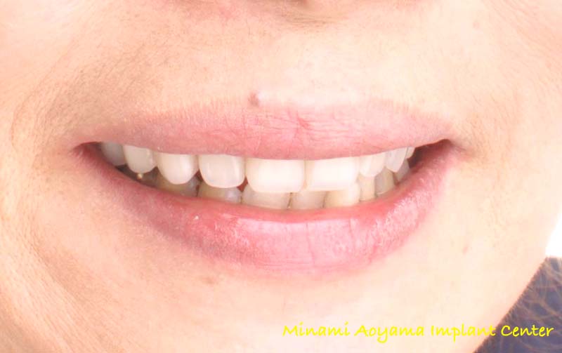 オールオンフォー（上顎全歯抜歯後、インプラント義歯を即日装着） 症例写真6