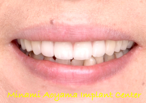 オールオンフォー（上顎全歯抜歯後、インプラント義歯を即日装着） 症例写真9