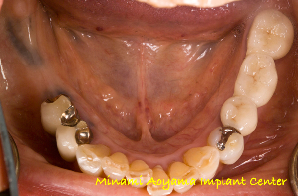 奥歯にインプラント治療を行った症例1 症例写真1