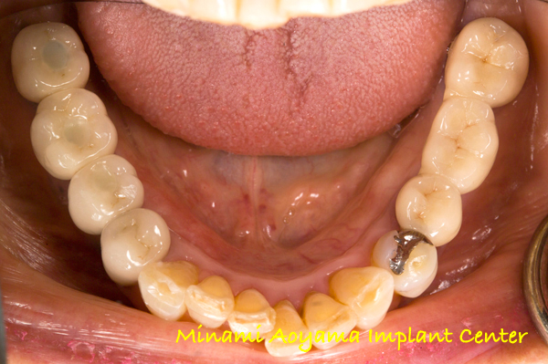 奥歯にインプラント治療を行った症例1 症例写真3