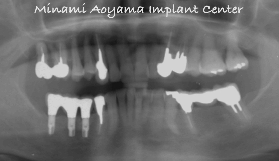 奥歯にインプラント治療を行った症例1 症例写真4