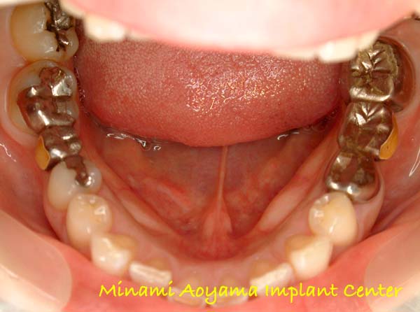 奥歯にインプラント治療を行った症例2 症例写真1