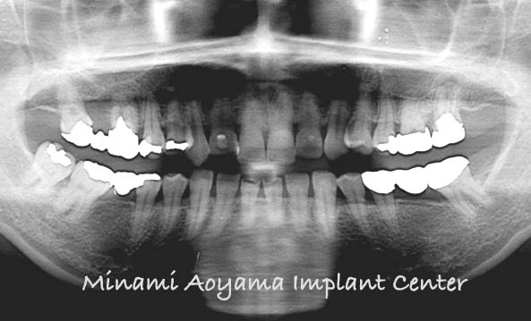 奥歯にインプラント治療を行った症例2 症例写真2