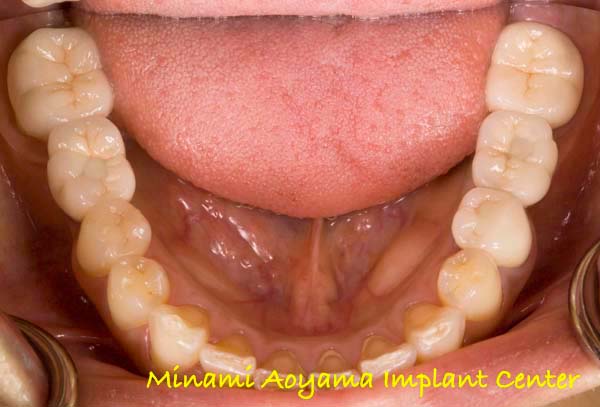 奥歯にインプラント治療を行った症例2 症例写真3