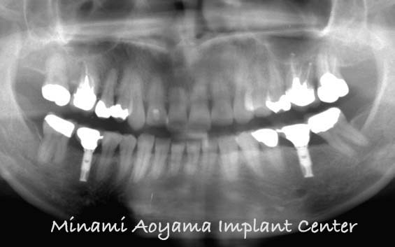 奥歯にインプラント治療を行った症例2 症例写真4