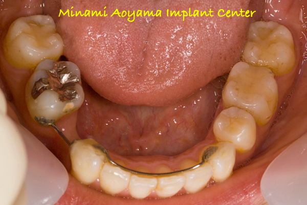 奥歯（小臼歯）にインプラント治療を行った症例3 症例写真1