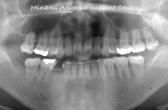 奥歯（小臼歯）にインプラント治療を行った症例3 症例写真2