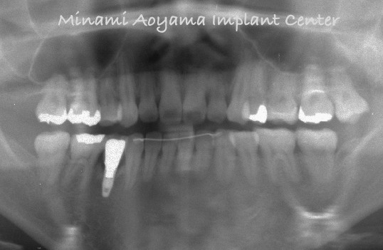 奥歯（小臼歯）にインプラント治療を行った症例3 症例写真4