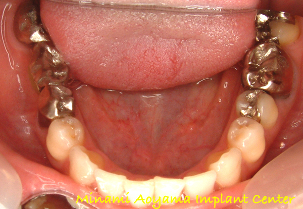 奥歯にインプラント治療を行った症例4 症例写真1