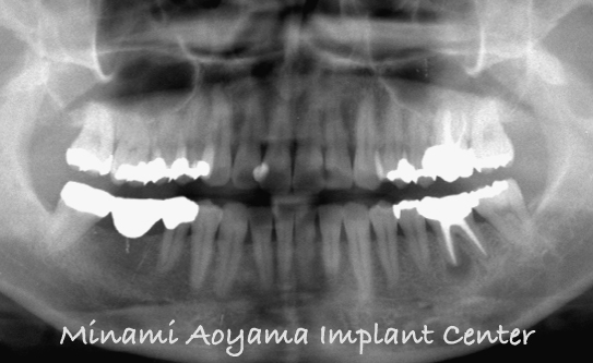 奥歯にインプラント治療を行った症例4 症例写真2