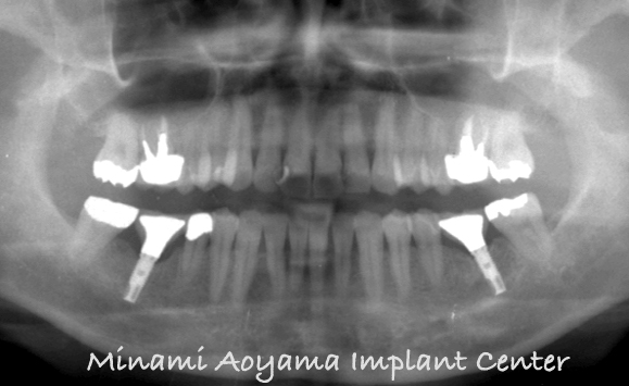 奥歯にインプラント治療を行った症例4 症例写真4