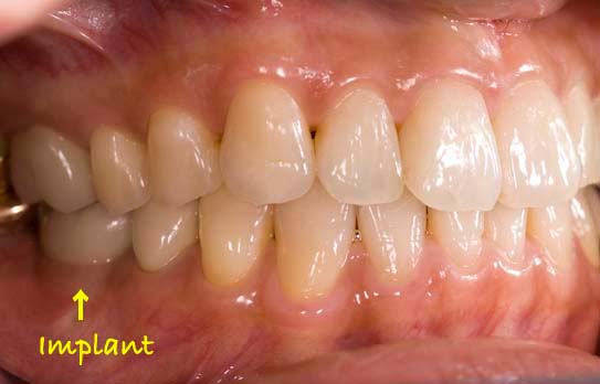 奥歯にインプラント治療を行った症例4 症例写真5