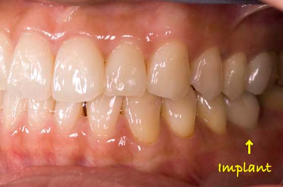 奥歯にインプラント治療を行った症例4 症例写真6
