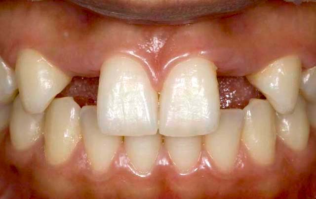 上顎左右側切歯　先天欠損症例 症例写真1