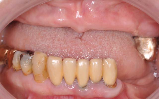 インプラントによる全顎的な審美と機能の改善例1 症例写真1
