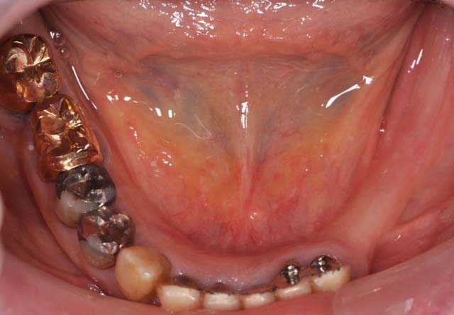 インプラントによる全顎的な審美と機能の改善例1 症例写真3
