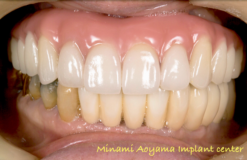 インプラントによる全顎的な審美と機能の改善例1 症例写真5