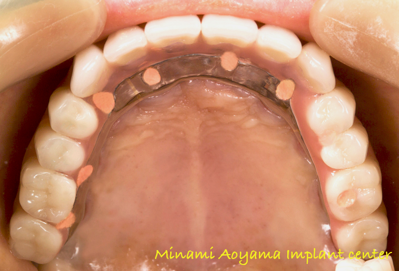 インプラントによる全顎的な審美と機能の改善例1 症例写真7
