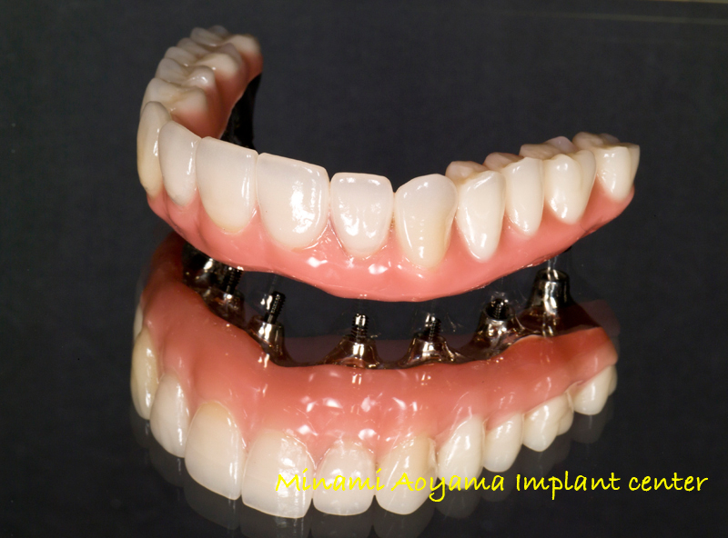インプラントによる全顎的な審美と機能の改善例1 症例写真9