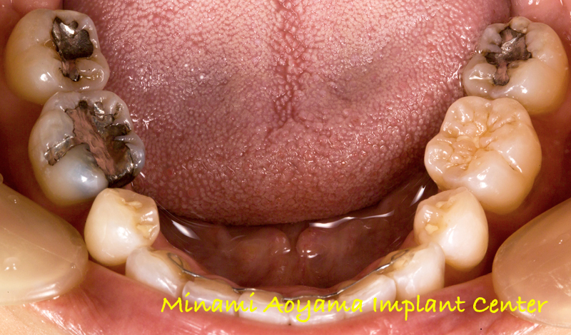 臼歯セラミック修復ケース 症例写真1